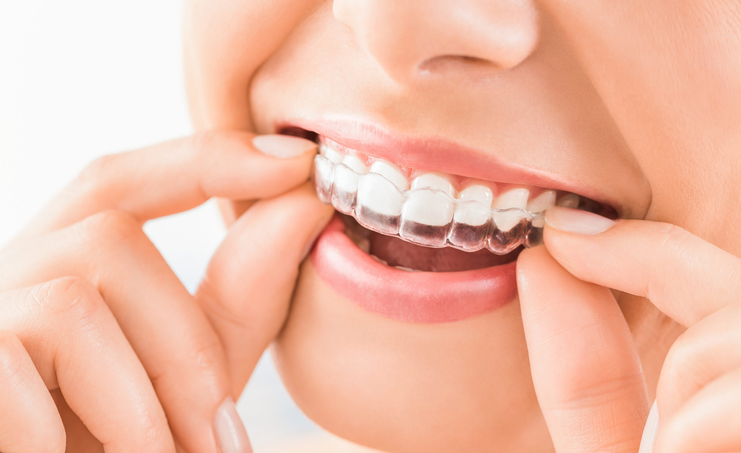 Invisalign in San Jose clear aligners